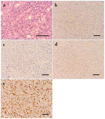 Frontiers Case Report A Rare Case Of Triple Negative Breast Cancer